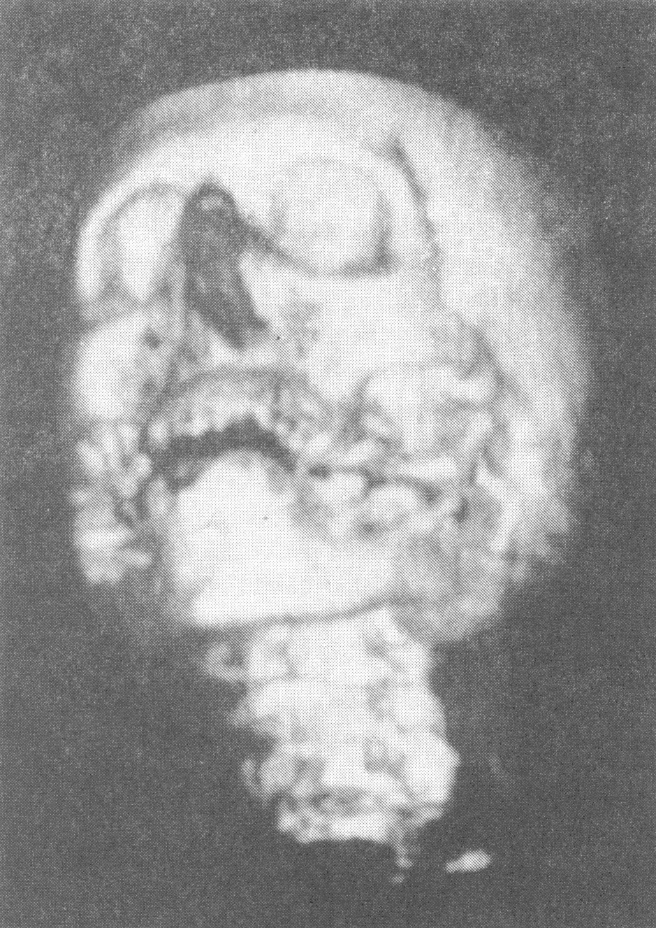 3D CT data rendered on the Edinburgh University Super Computer