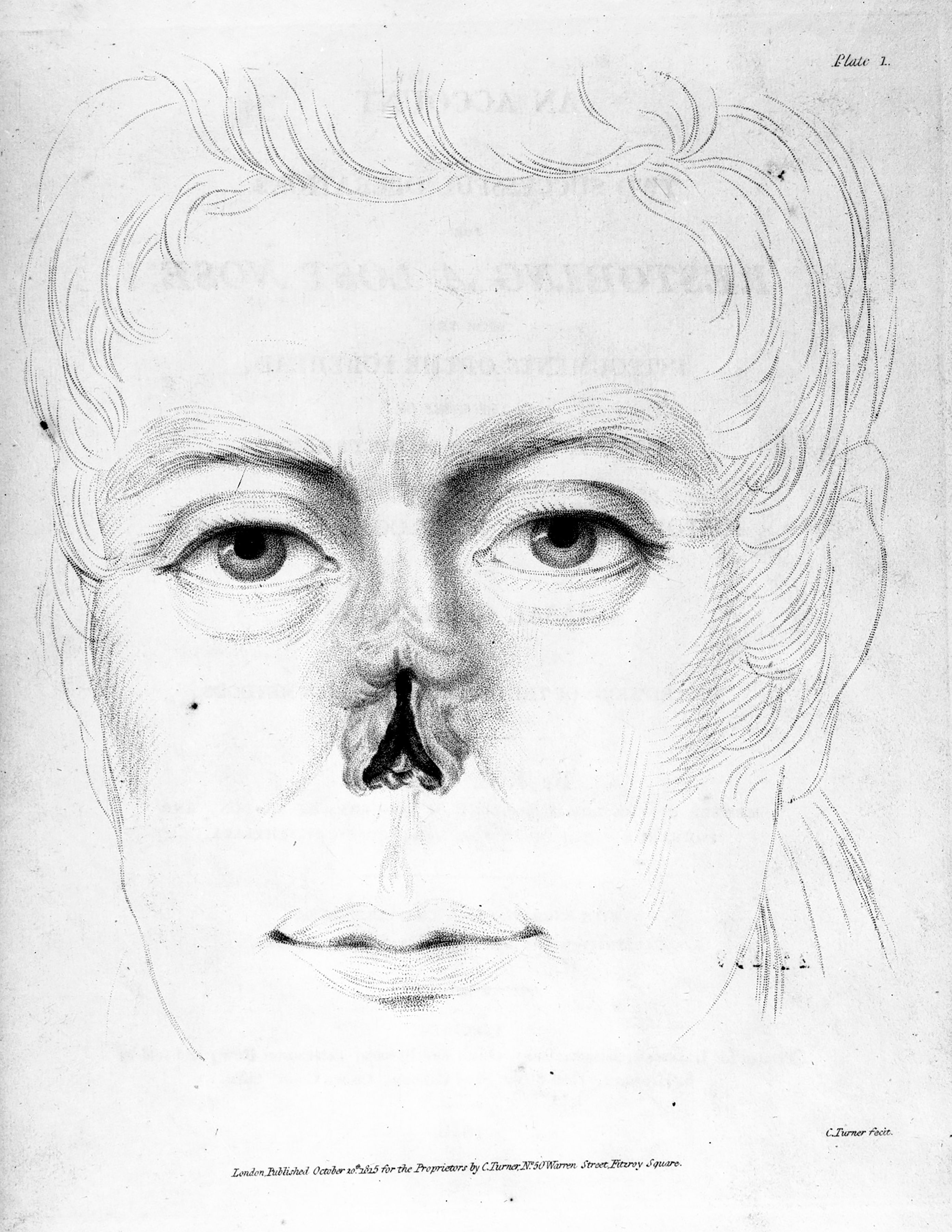 Joseph Carpue, Opérations de chirurgie reconstructive du nez, 1816