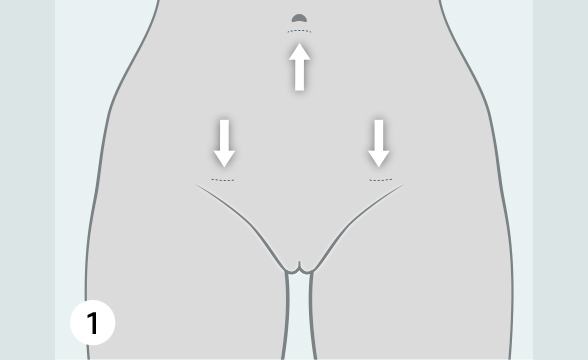 (Quelle: BIÖG) Es werden drei kleine Schnitte für die OP-Instrumente gemacht: am Bauchnabel und links und rechts im Bereich der Schamhaargrenze.