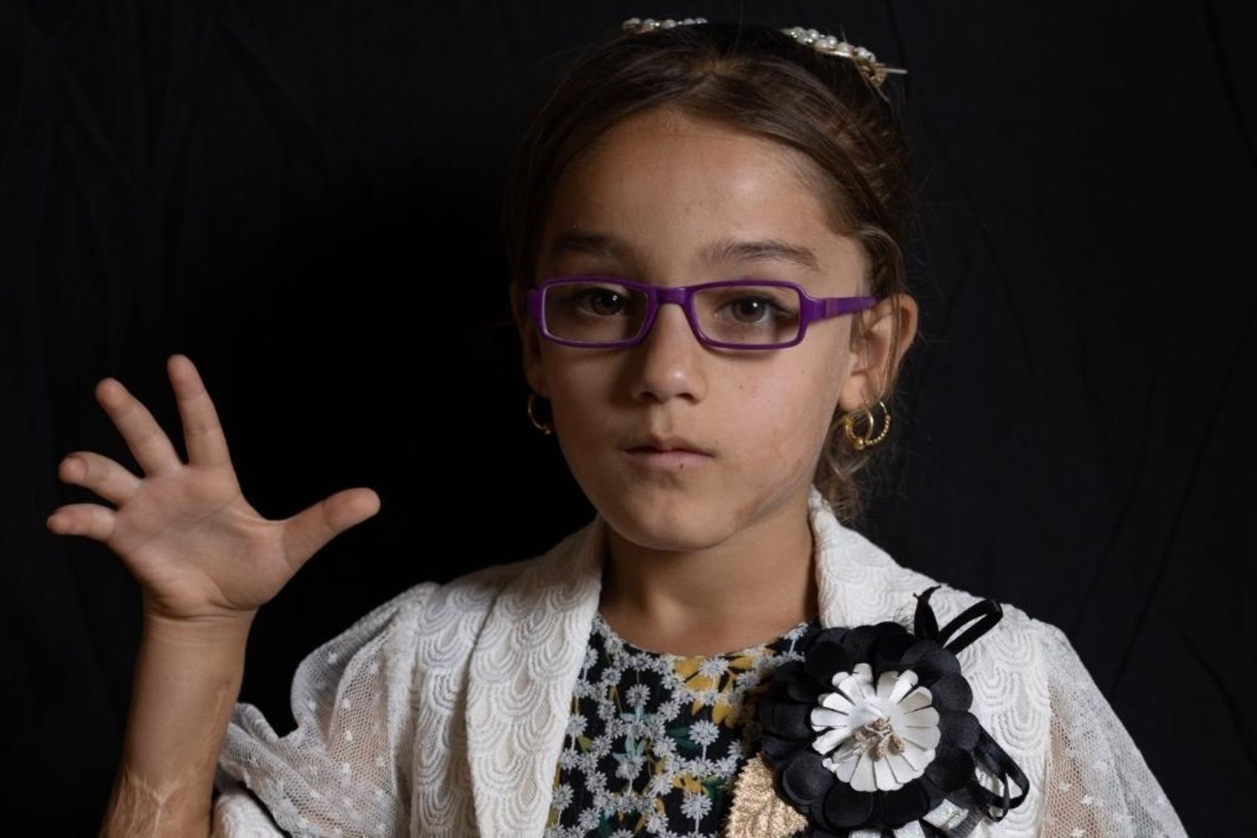 Ein junges Mädchen schaut ernst in die Kamera. An ihren Armen und Händen sieht man schwere Narben des Unfalls.