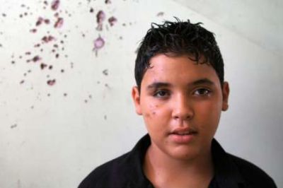 Ein Junge wurde durch Streumunition verletzt. Splitter trafen ihn ihm Gesicht und seiner Hand. Hier ist er im Portrait vor einer weißen Wand zu sehen.