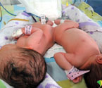 赣州一孕妇产下连体婴儿