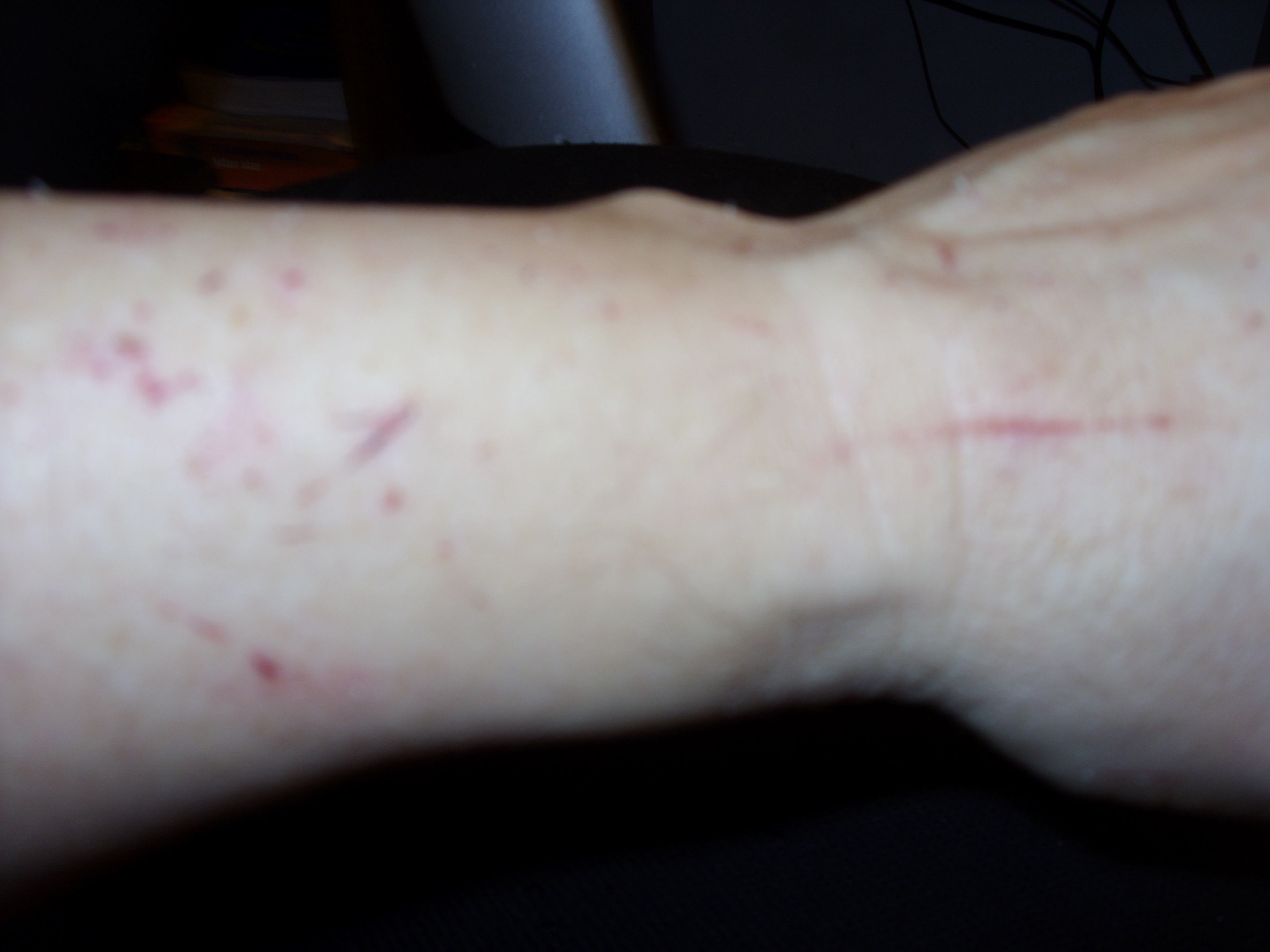 Cat Scratch Fever