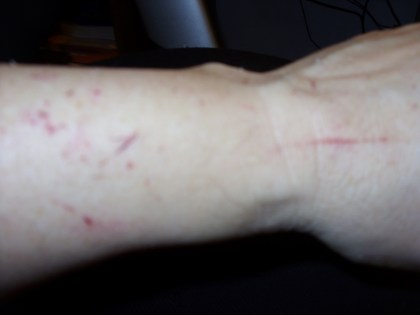 Cat Scratch Fever