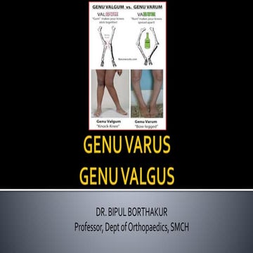 Genu varus and valgus