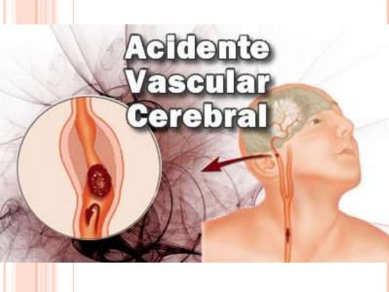Acidente vascular cerebral final