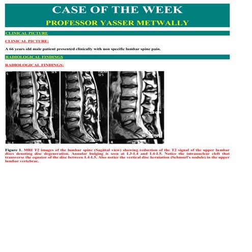 Case record...Lumbar spondylosis
