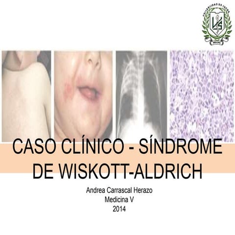 SINDROME WISKOTT-ALDRICH