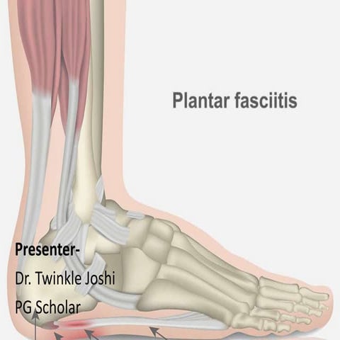 Plantar fasciitis.pptx