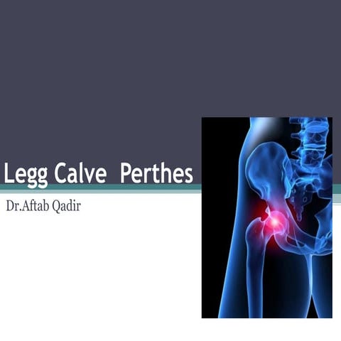 Legg calve perthes