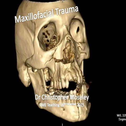 Maxillofacial trauma
