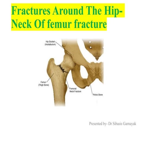 Neck Of femur fracture.pptx