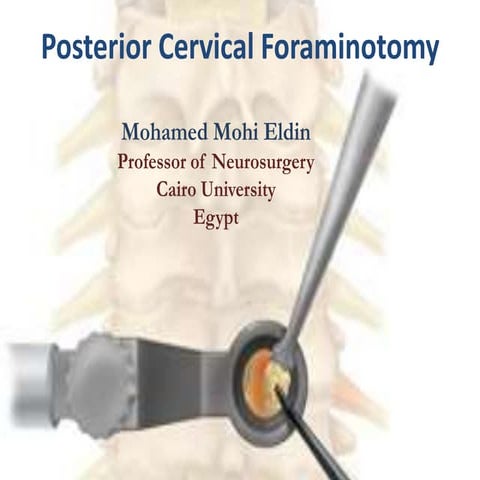 Posterior foraminotomy for cervical disc herniation