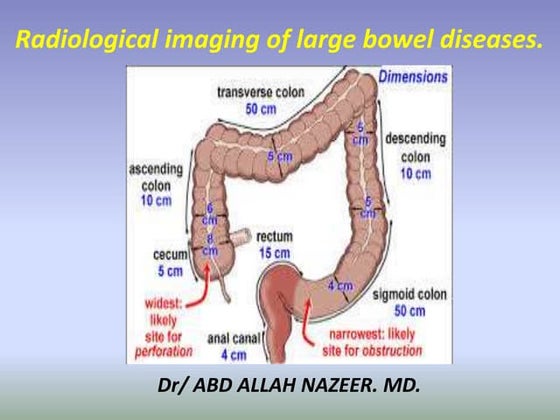 Presentation1.pptx, radiological imaging of large bowel diseases