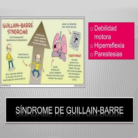 Síndrome de-guillain-barre