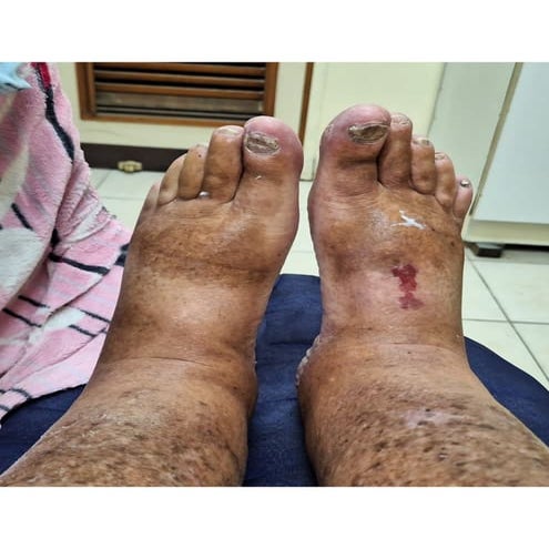 My swollen feet due to heart problem at Allenby 91