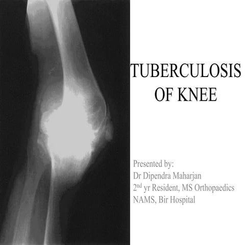Tuberculosis of knee