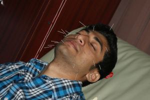 acupuncture treatment