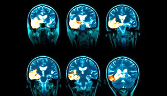 M170365-Herpes_encephalitis