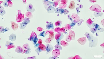 uterus lining map endometriosis uterus lining map endometriosis