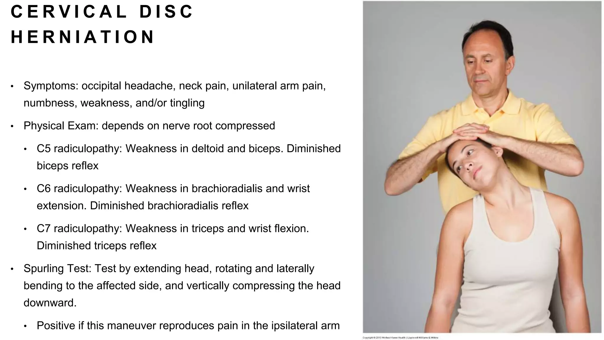C E R V I C A L D I S C
H E R N I A T I O N
• Symptoms: occipital headache, neck pain, unilateral arm pain,
numbness, weakness, and/or tingling
• Physical Exam: depends on nerve root compressed
• C5 radiculopathy: Weakness in deltoid and biceps. Diminished
biceps reflex
• C6 radiculopathy: Weakness in brachioradialis and wrist
extension. Diminished brachioradialis reflex
• C7 radiculopathy: Weakness in triceps and wrist flexion.
Diminished triceps reflex
• Spurling Test: Test by extending head, rotating and laterally
bending to the affected side, and vertically compressing the head
downward.
• Positive if this maneuver reproduces pain in the ipsilateral arm
 