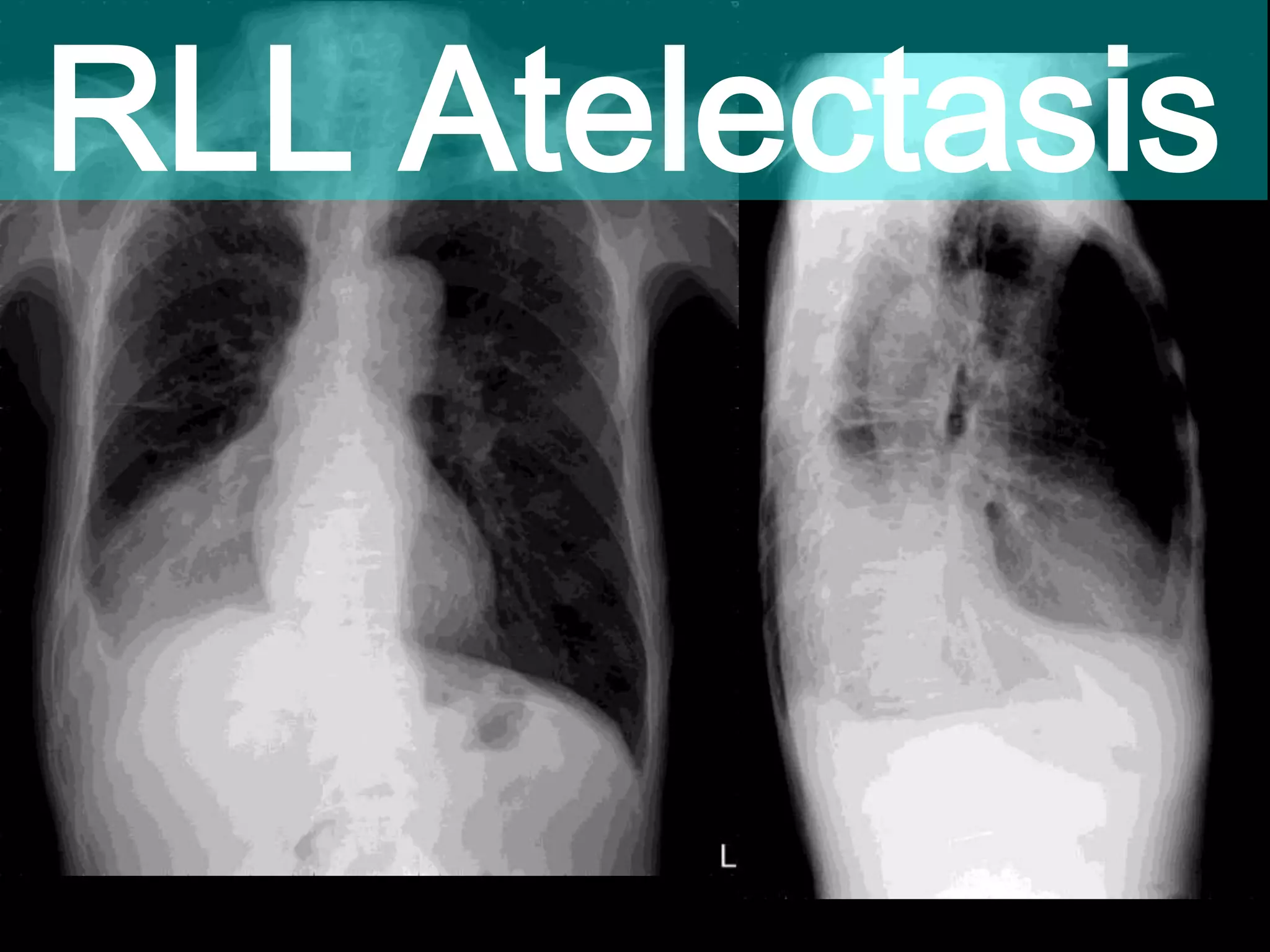 RLL Atelectasis
 