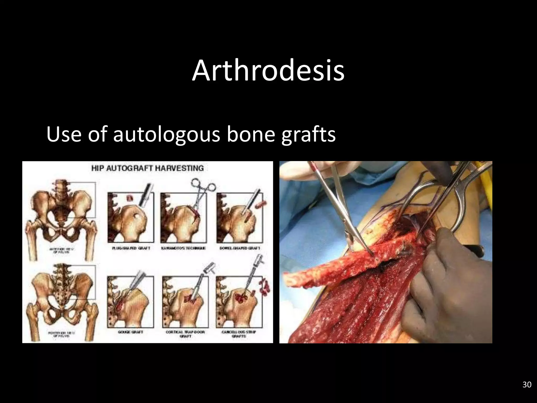 Arthrodesis
Use of autologous bone grafts
30
 