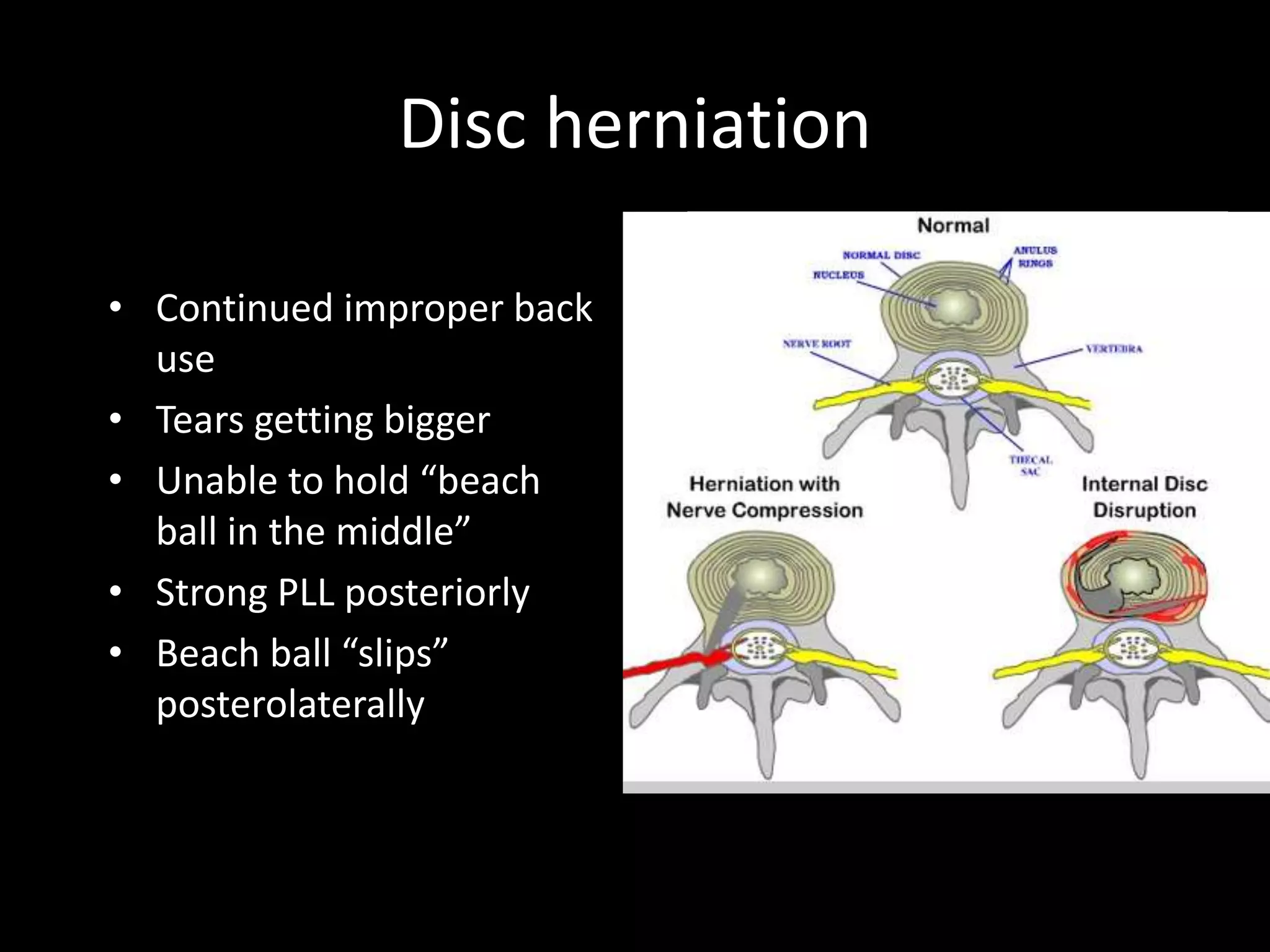 Disc herniation
• Continued improper back
use
• Tears getting bigger
• Unable to hold “beach
ball in the middle”
• Strong PLL posteriorly
• Beach ball “slips”
posterolaterally
 