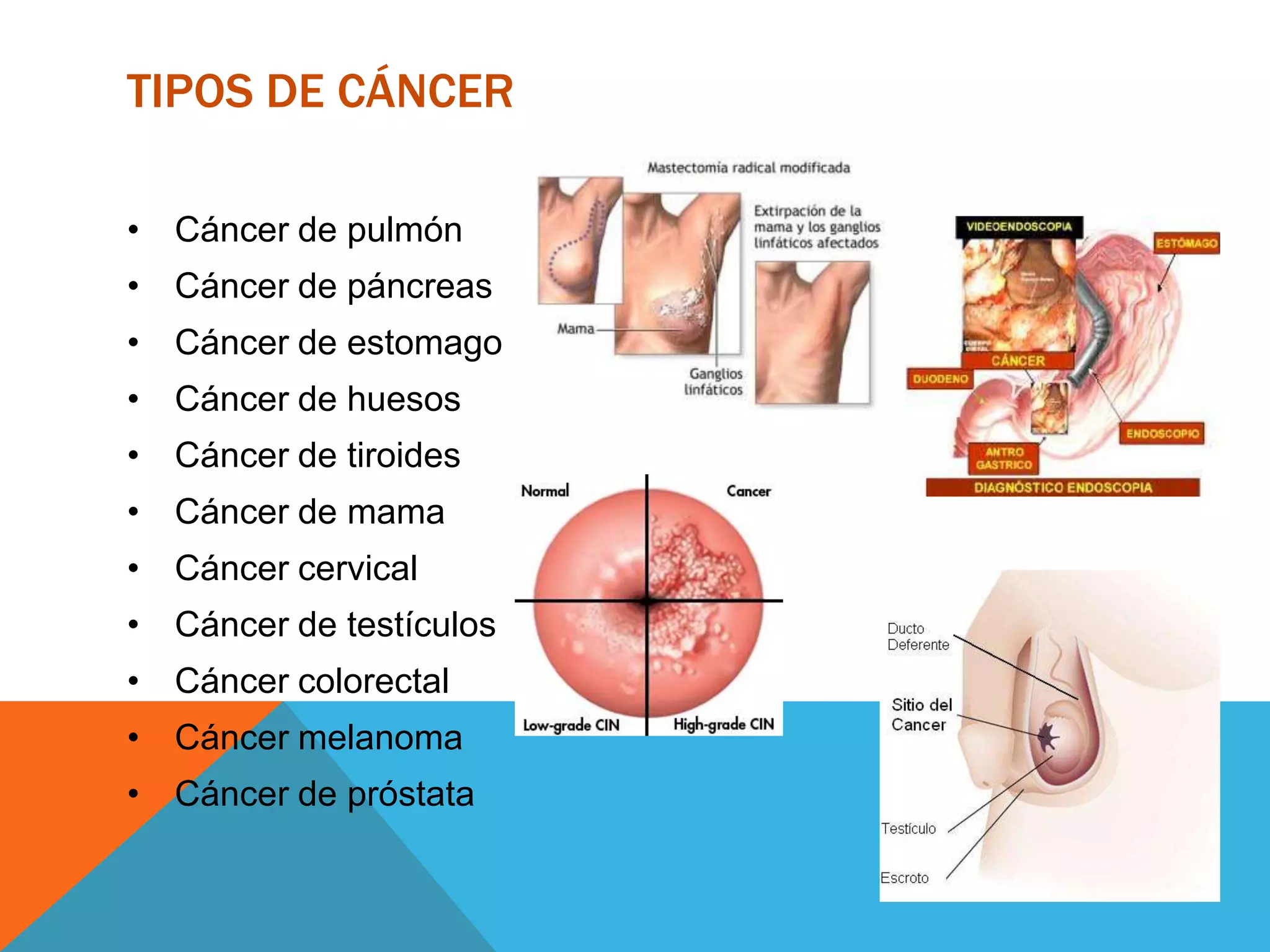 TIPOS DE CÁNCER

• Cáncer de pulmón
• Cáncer de páncreas
• Cáncer de estomago
• Cáncer de huesos
• Cáncer de tiroides
• Cáncer de mama
• Cáncer cervical
• Cáncer de testículos
• Cáncer colorectal
• Cáncer melanoma
• Cáncer de próstata
 