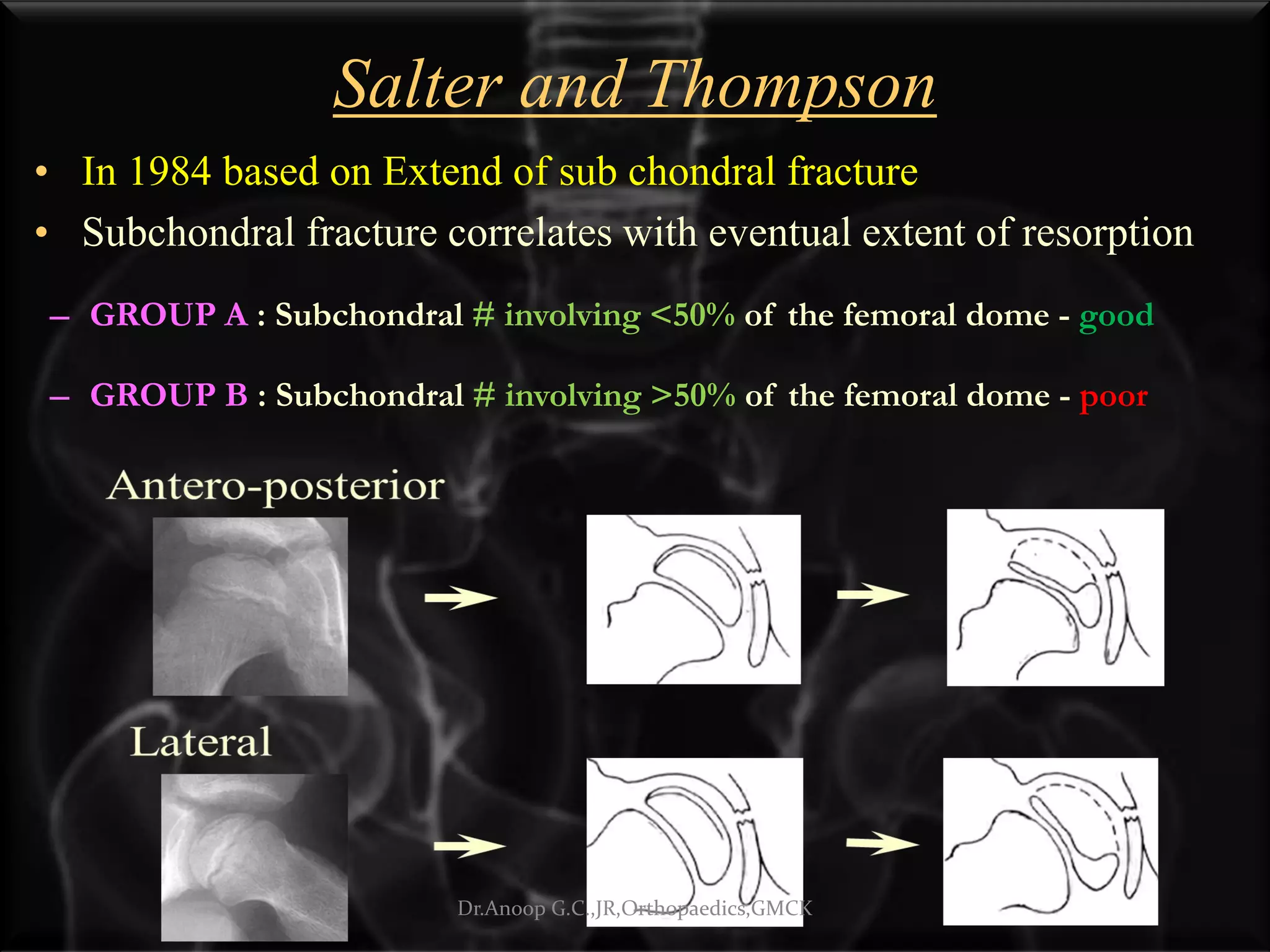 Salter and Thompson
• In 1984 based on Extend of sub chondral fracture
• Subchondral fracture correlates with eventual extent of resorption
– GROUP A : Subchondral # involving <50% of the femoral dome - good
– GROUP B : Subchondral # involving >50% of the femoral dome - poor
Dr.Anoop G.C.,JR,Orthopaedics,GMCK
 