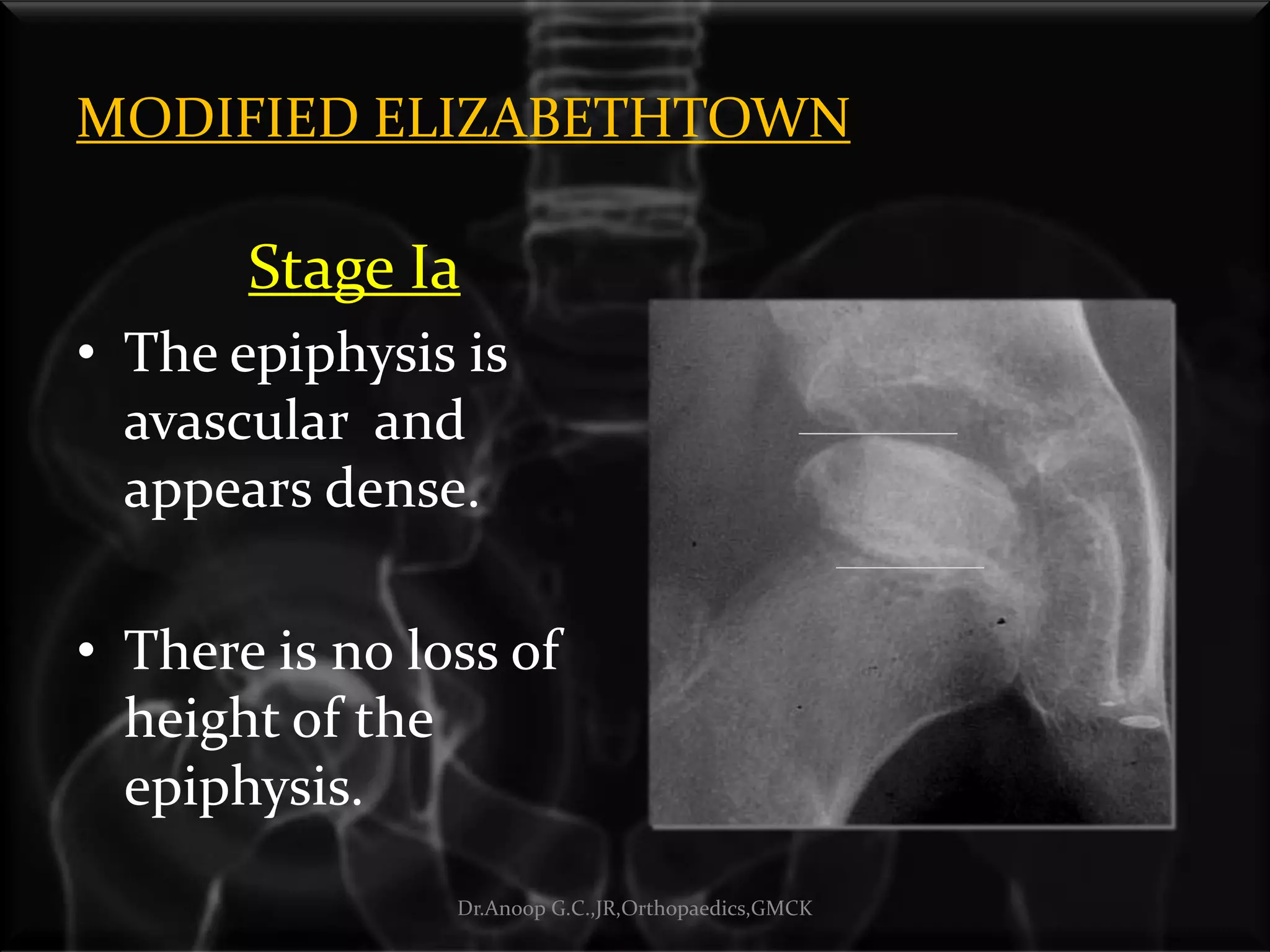 MODIFIED ELIZABETHTOWN
Stage Ia
• The epiphysis is
avascular and
appears dense.
• There is no loss of
height of the
epiphysis.
Dr.Anoop G.C.,JR,Orthopaedics,GMCK
 