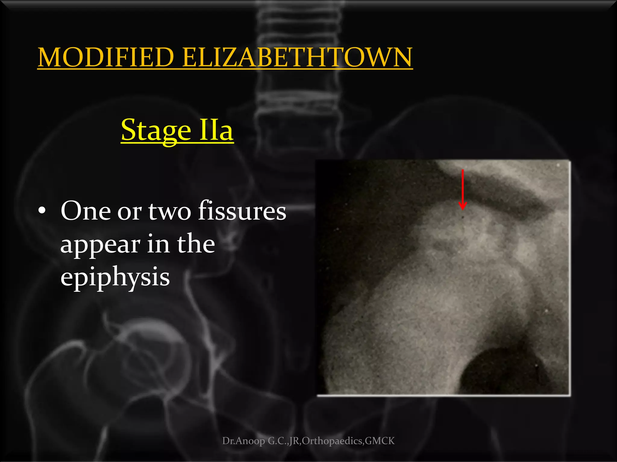 MODIFIED ELIZABETHTOWN
Stage IIa
• One or two fissures
appear in the
epiphysis
Dr.Anoop G.C.,JR,Orthopaedics,GMCK
 