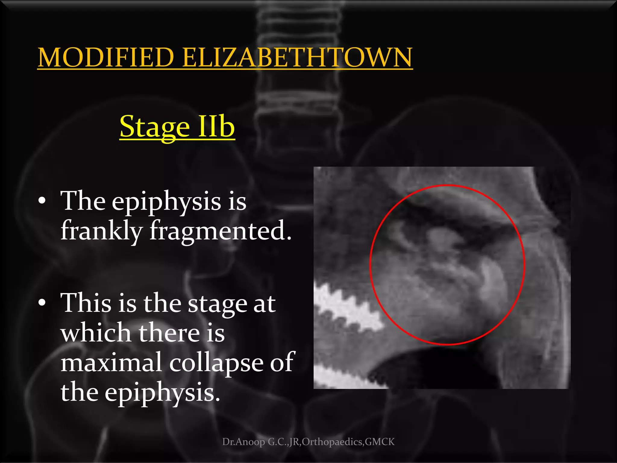 MODIFIED ELIZABETHTOWN
Stage IIb
• The epiphysis is
frankly fragmented.
• This is the stage at
which there is
maximal collapse of
the epiphysis.
Dr.Anoop G.C.,JR,Orthopaedics,GMCK
 