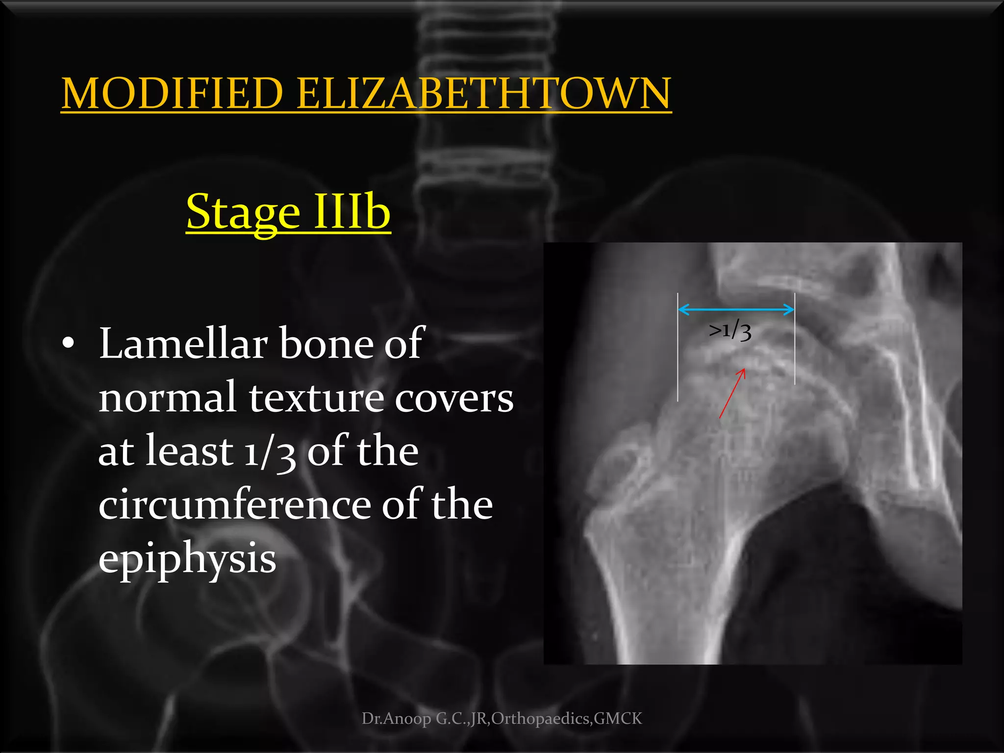 MODIFIED ELIZABETHTOWN
Stage IIIb
• Lamellar bone of
normal texture covers
at least 1/3 of the
circumference of the
epiphysis
Dr.Anoop G.C.,JR,Orthopaedics,GMCK
>1/3
 