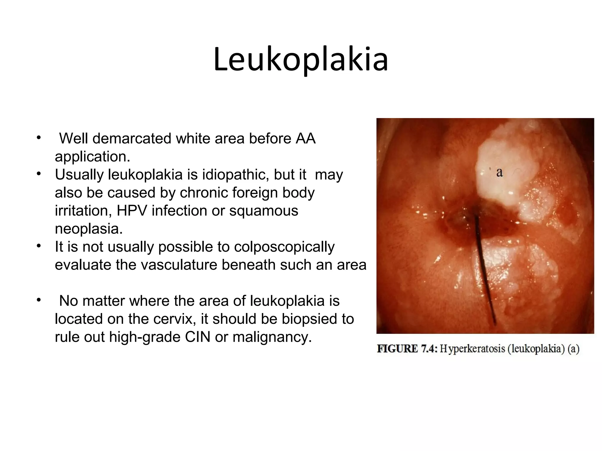 Leukoplakia
•

Well demarcated white area before AA
application.
• Usually leukoplakia is idiopathic, but it may
also be caused by chronic foreign body
irritation, HPV infection or squamous
neoplasia.
• It is not usually possible to colposcopically
evaluate the vasculature beneath such an area
•

No matter where the area of leukoplakia is
located on the cervix, it should be biopsied to
rule out high-grade CIN or malignancy.

 