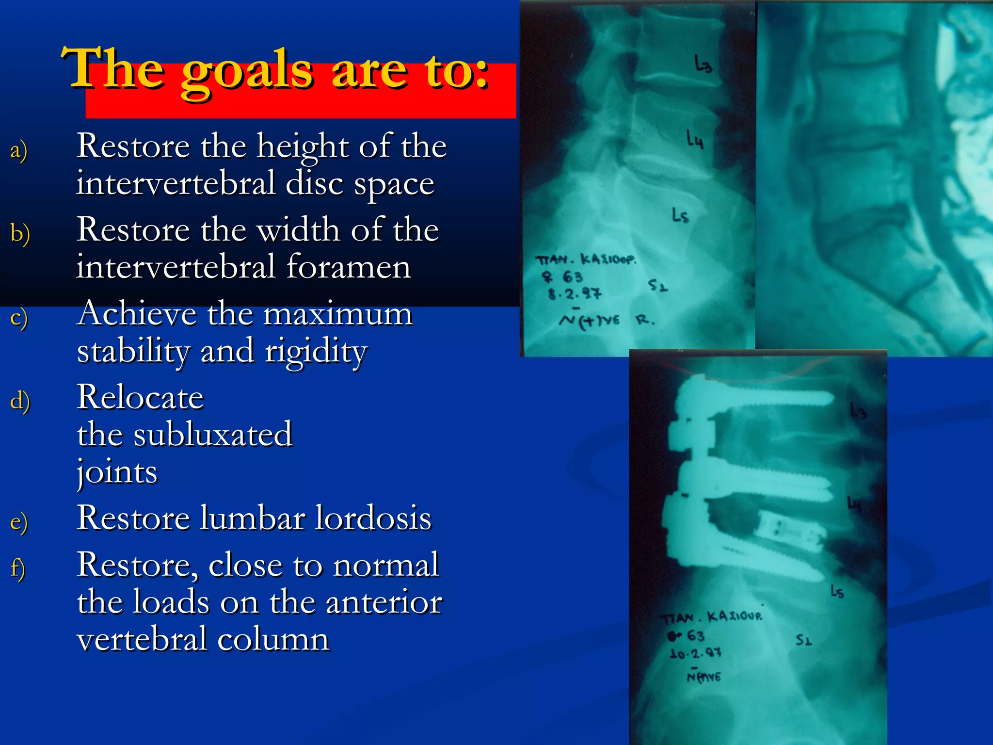 The goals are to:The goals are to:
a)a) Restore the height of theRestore the height of the
intervertebral disc spaceintervertebral disc space
b)b) Restore the width of theRestore the width of the
intervertebral foramenintervertebral foramen
c)c) Achieve the maximumAchieve the maximum
stability and rigiditystability and rigidity
d)d) RelocateRelocate
the subluxatedthe subluxated
jointsjoints
e)e) Restore lumbar lordosisRestore lumbar lordosis
f)f) Restore, close to normalRestore, close to normal
the loads on the anteriorthe loads on the anterior
vertebral columnvertebral column
 