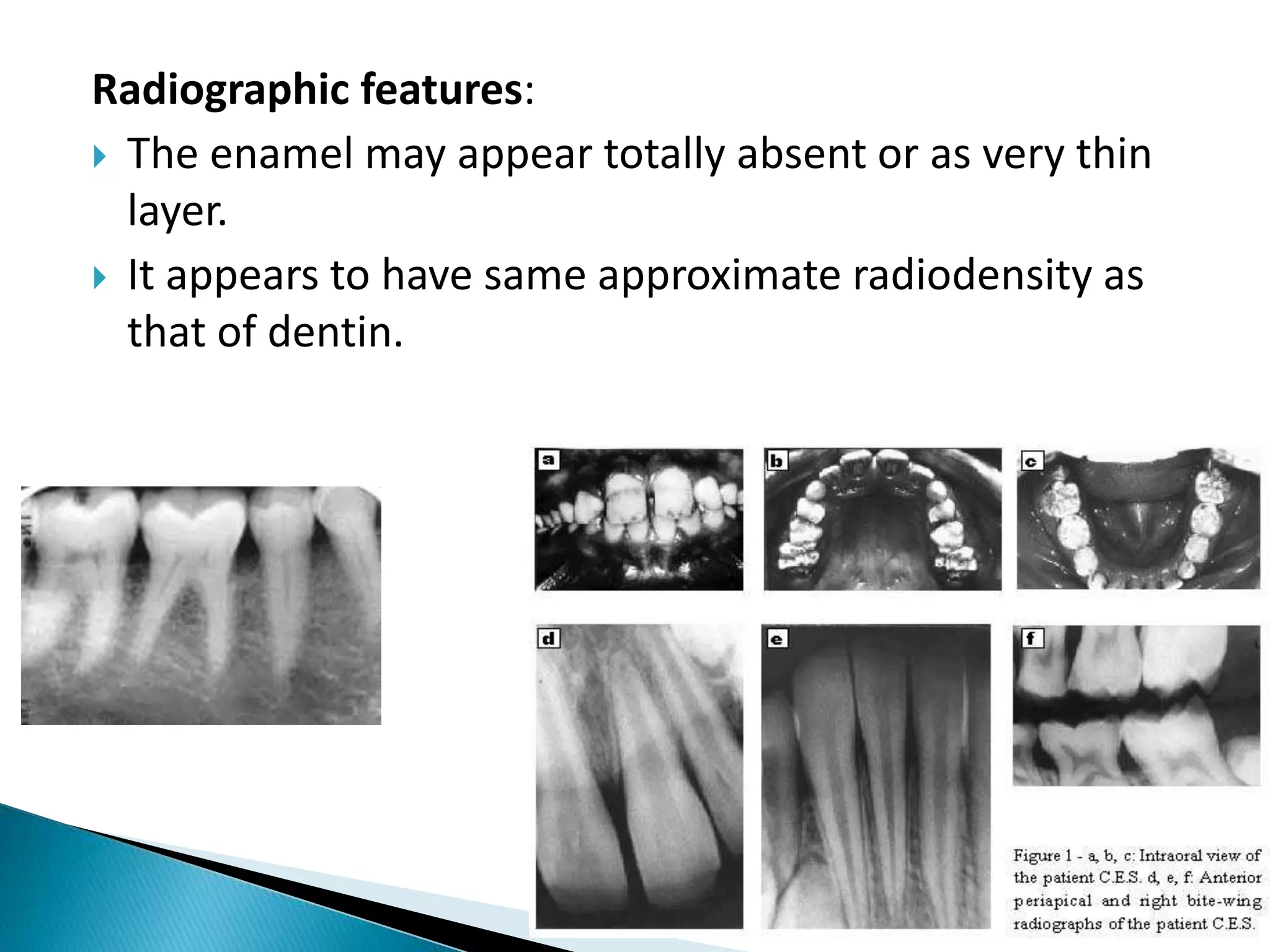 Radiographic features:
 The enamel may appear totally absent or as very thin
layer.
 It appears to have same approximate radiodensity as
that of dentin.
 