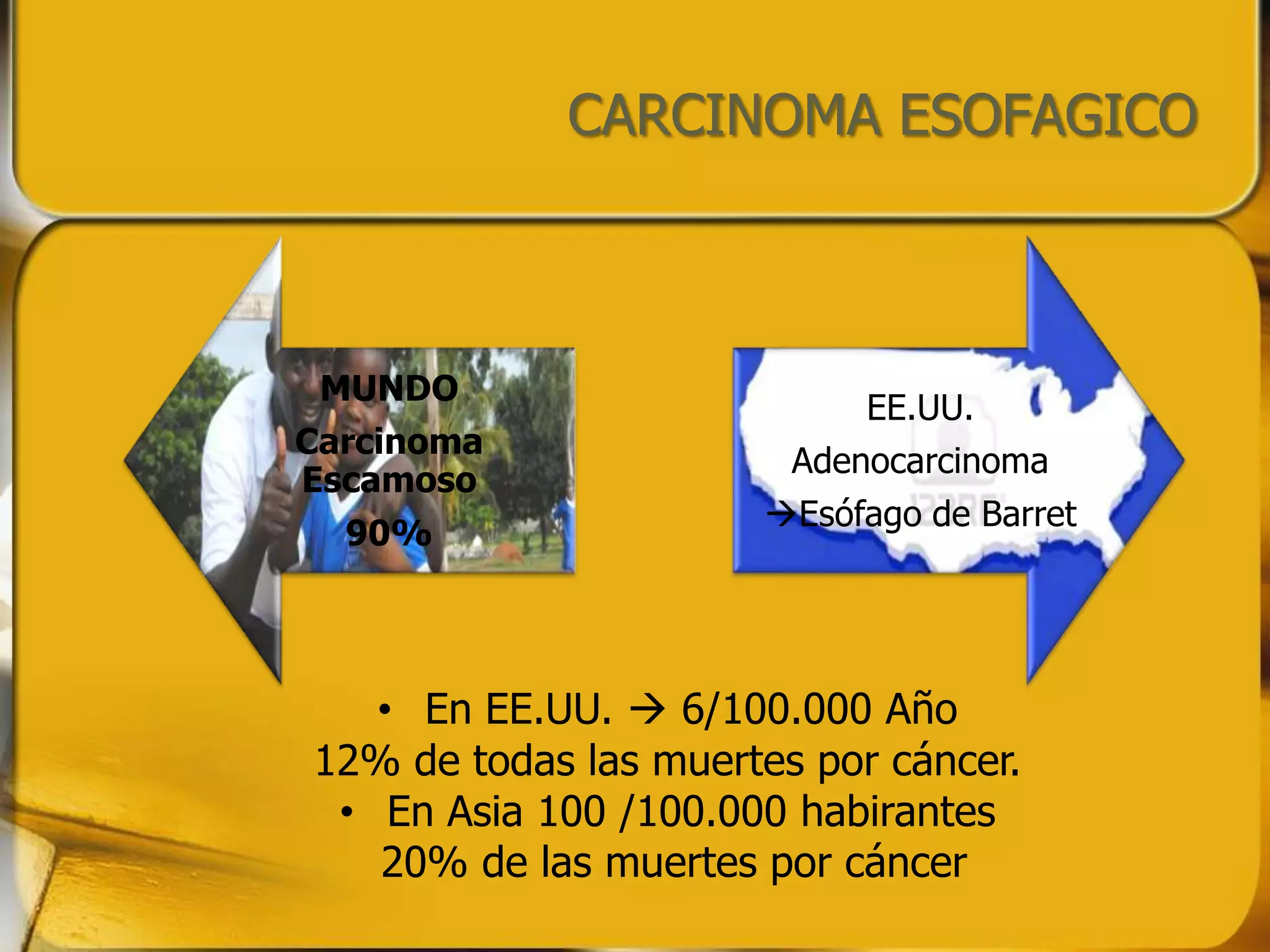 CARCINOMA ESOFAGICO



 MUNDO
                            EE.UU.
Carcinoma
                        Adenocarcinoma
Escamoso
                      Esófago de Barret
  90%




   • En EE.UU.  6/100.000 Año
12% de todas las muertes por cáncer.
 • En Asia 100 /100.000 habirantes
   20% de las muertes por cáncer
 