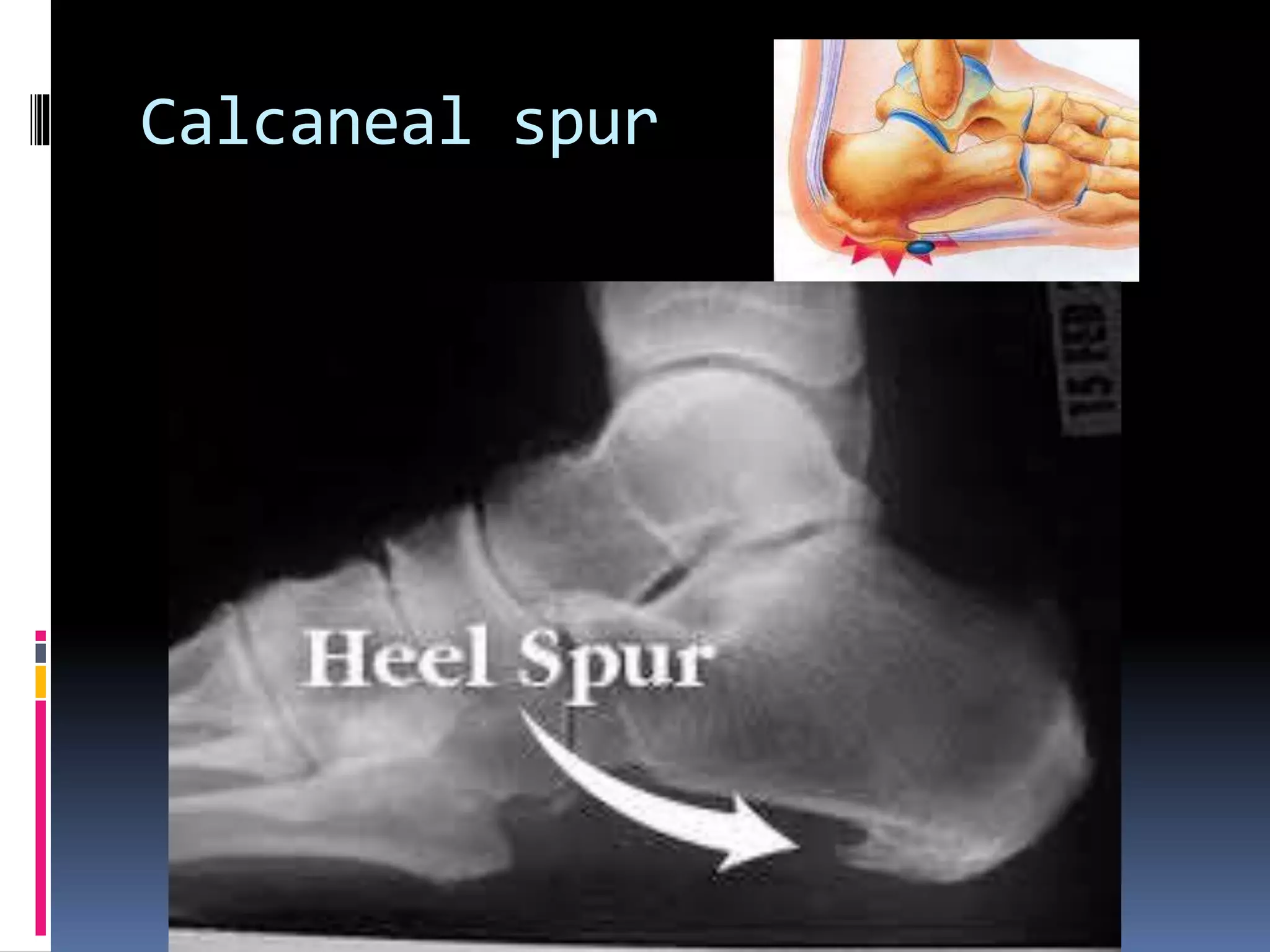 Calcaneal spur
 