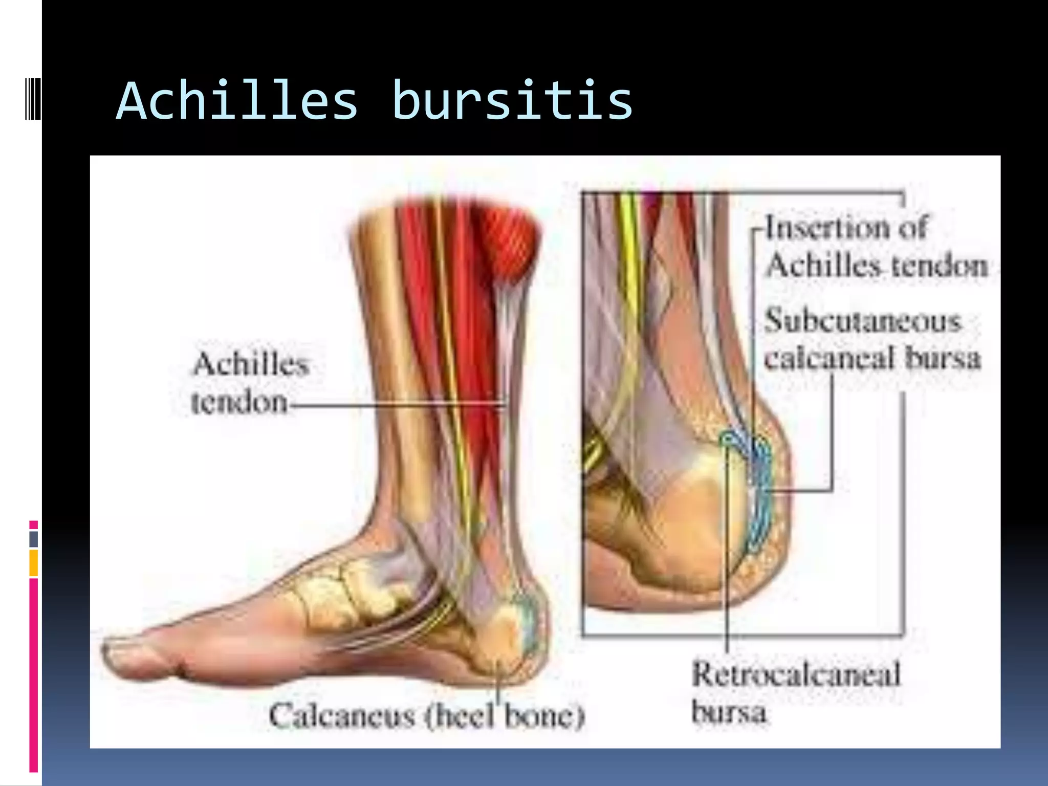 Achilles bursitis
 