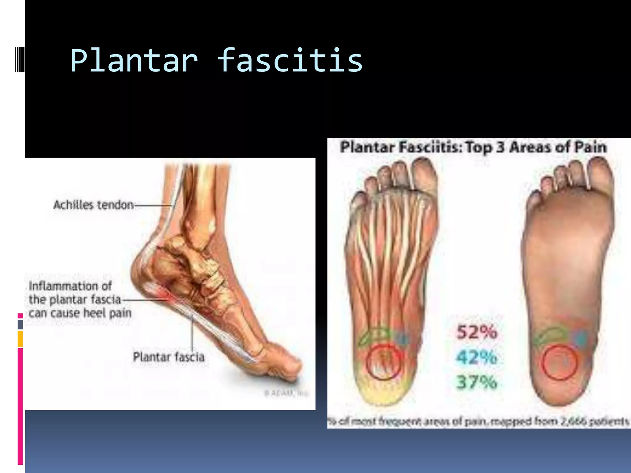 Plantar fascitis
 
