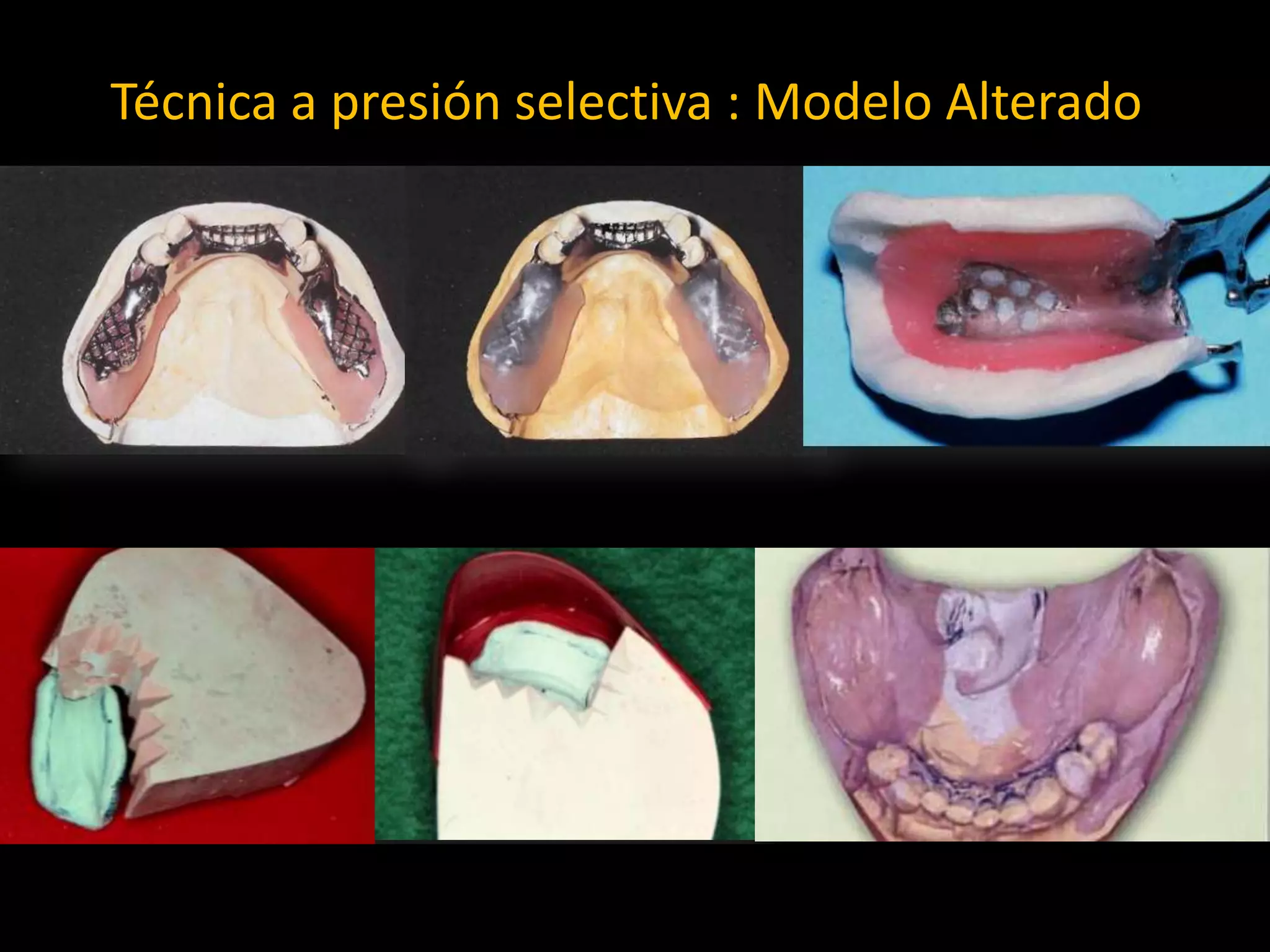 Técnica a presión selectiva : Modelo Alterado
 