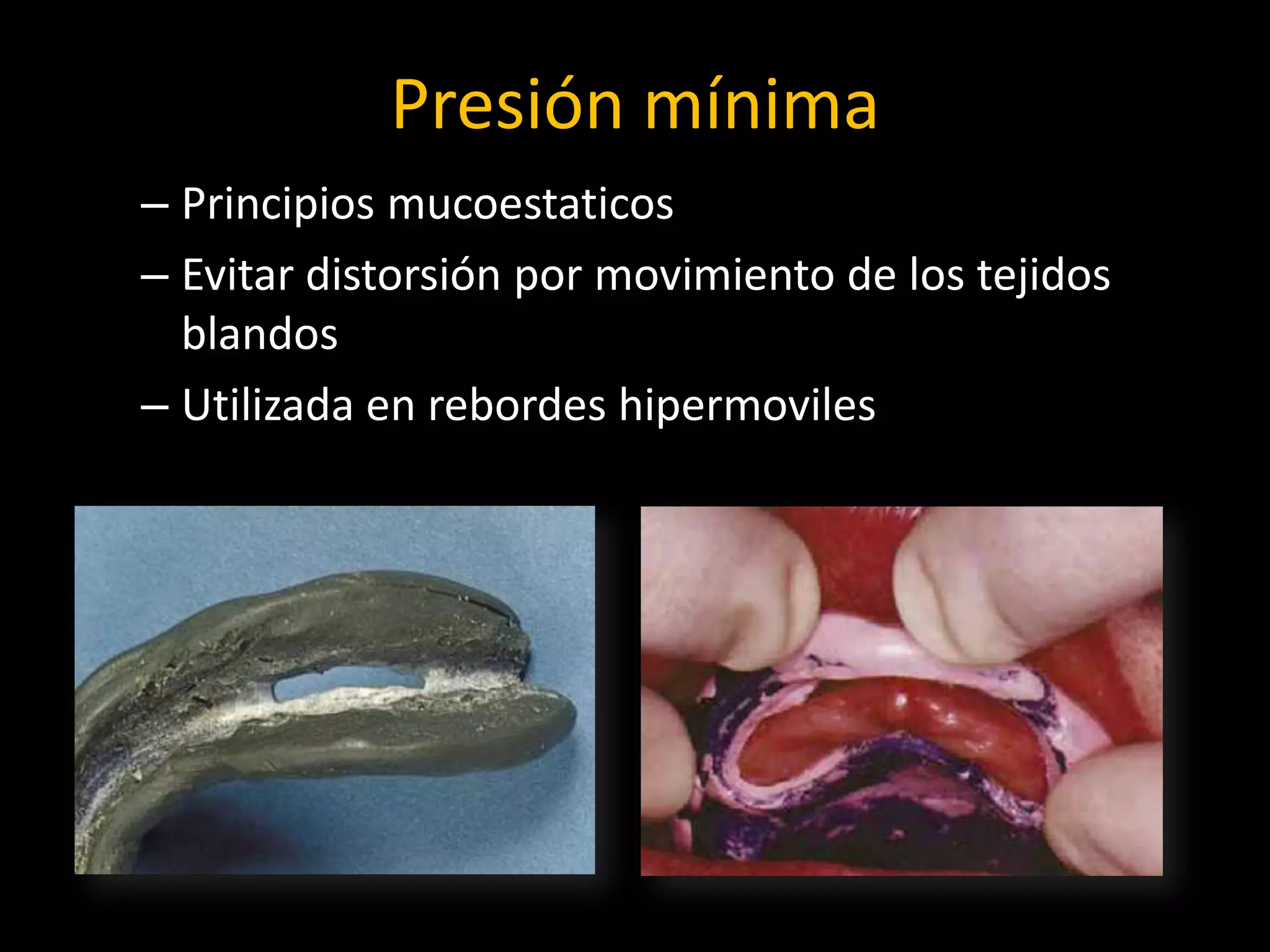 Presión mínima
– Principios mucoestaticos
– Evitar distorsión por movimiento de los tejidos
blandos
– Utilizada en rebordes hipermoviles
 