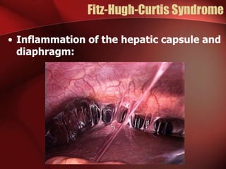 Fitz-Hugh-Curtis Syndrome
• Inflammation of the hepatic capsule and
diaphragm:

 