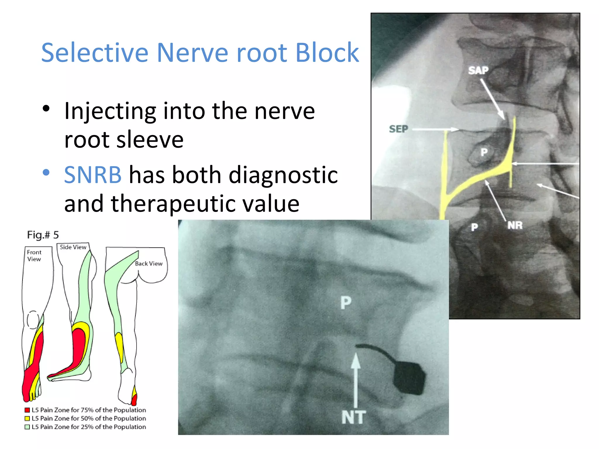 Selective Nerve root Block
• Injecting into the nerve
root sleeve
• SNRB has both diagnostic
and therapeutic value
 