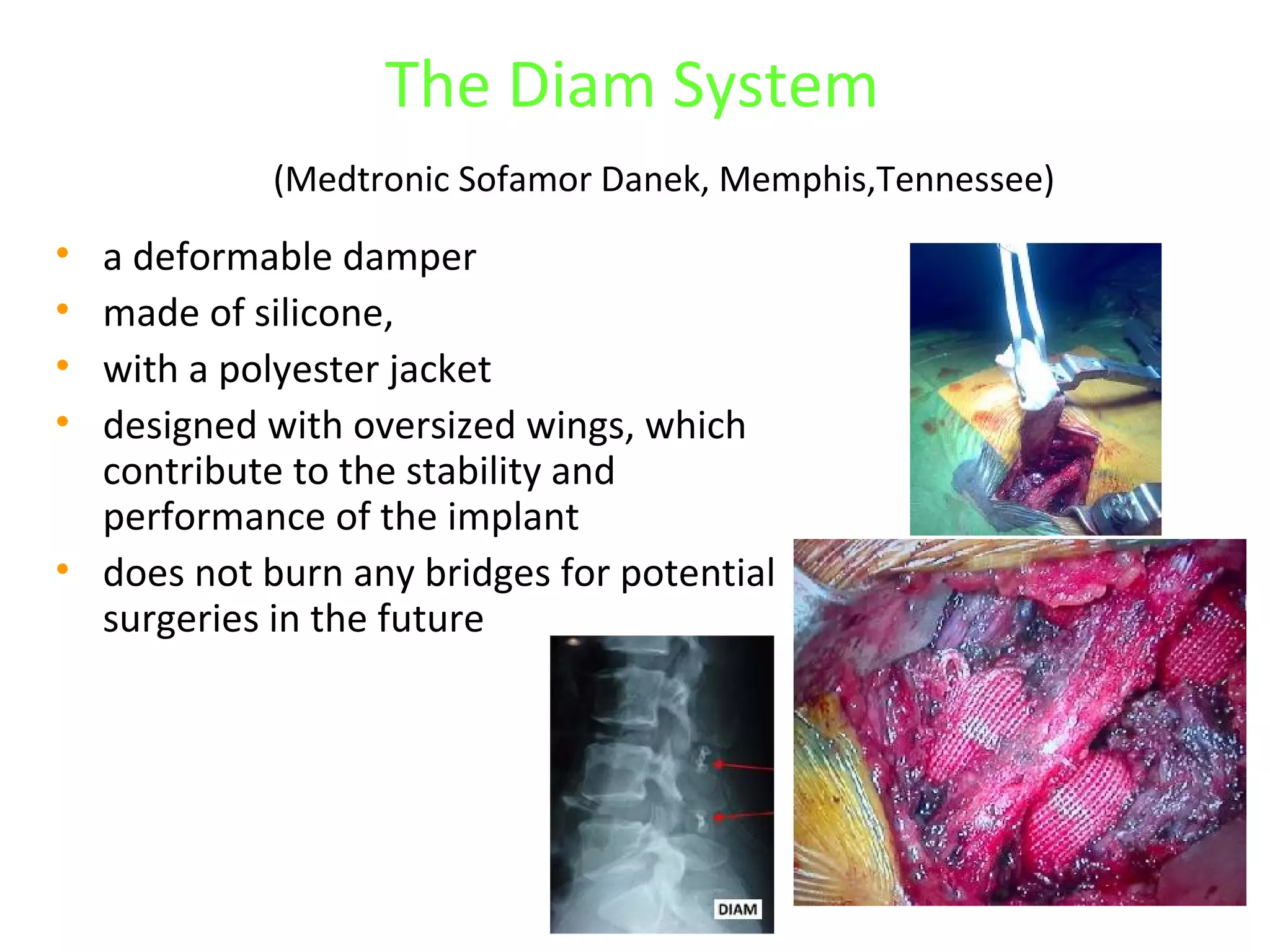 The Diam System
(Medtronic Sofamor Danek, Memphis,Tennessee)
• a deformable damper
• made of silicone,
• with a polyester jacket
• designed with oversized wings, which
contribute to the stability and
performance of the implant
• does not burn any bridges for potential
surgeries in the future
 
