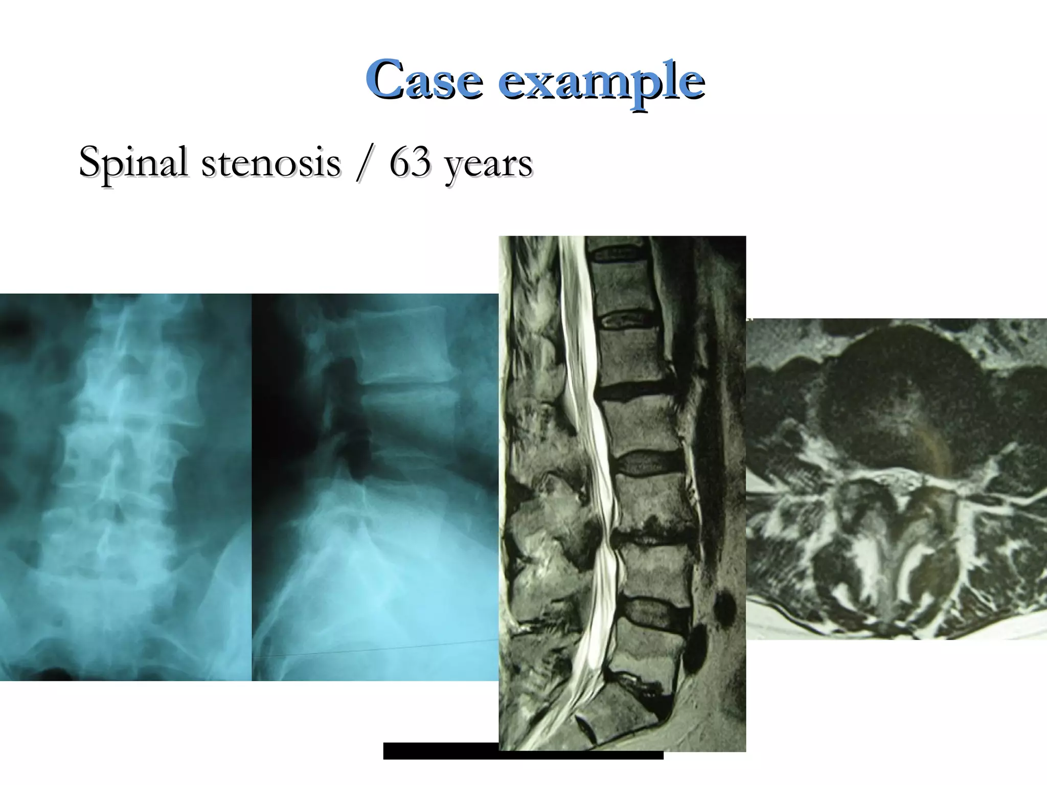 Spinal stenosis / 63 yearsSpinal stenosis / 63 years
Case exampleCase example
 