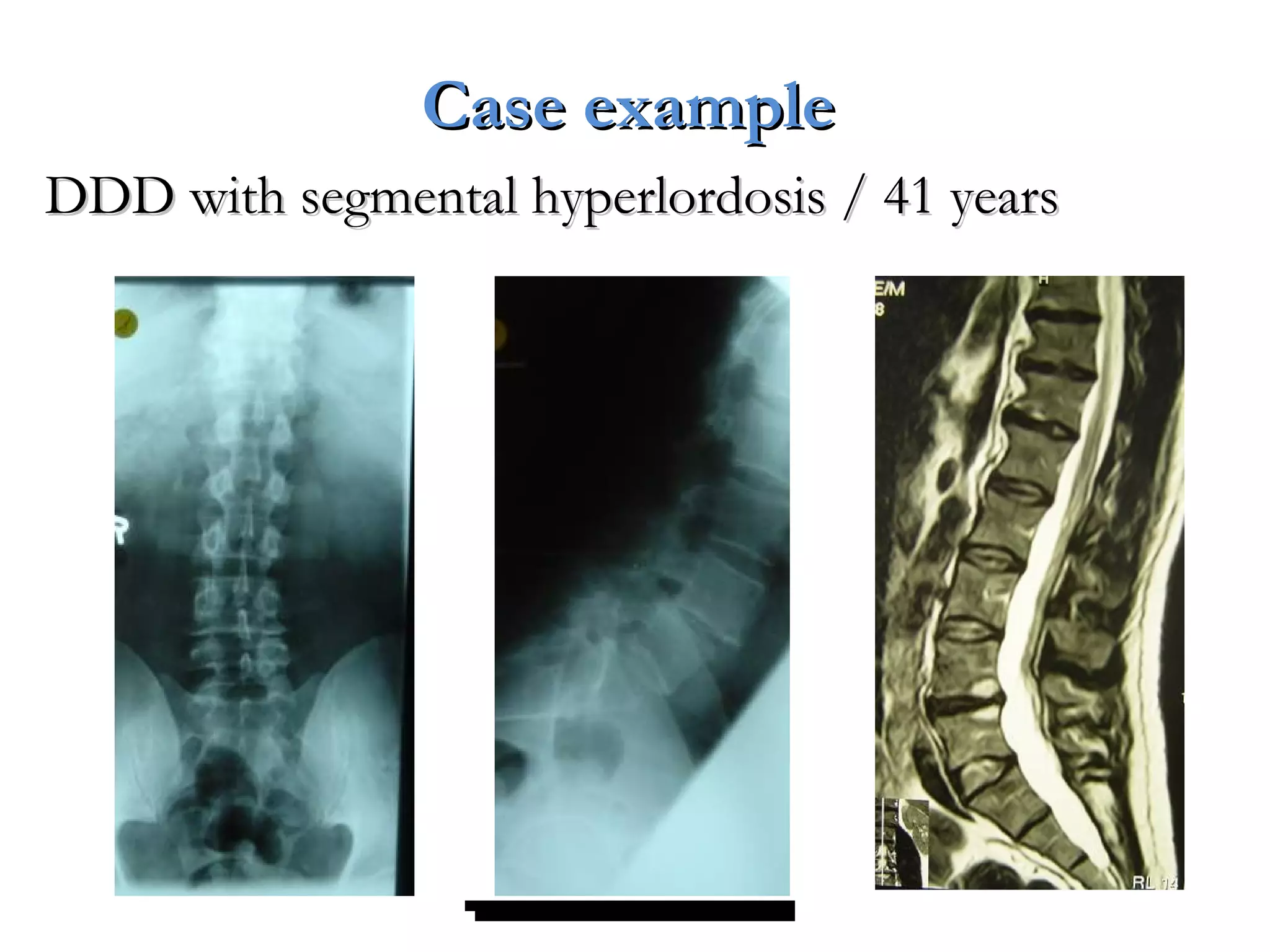 DDD with segmental hyperlordosis / 41 yearsDDD with segmental hyperlordosis / 41 years
Case exampleCase example
 