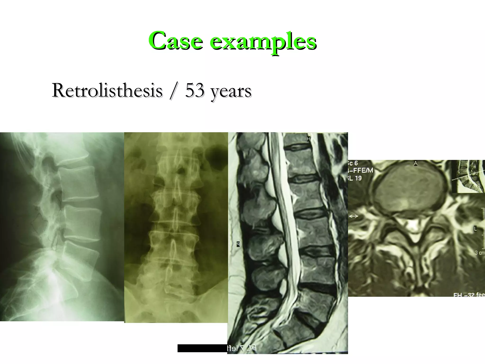 Retrolisthesis / 53 yearsRetrolisthesis / 53 years
Case examplesCase examples
 