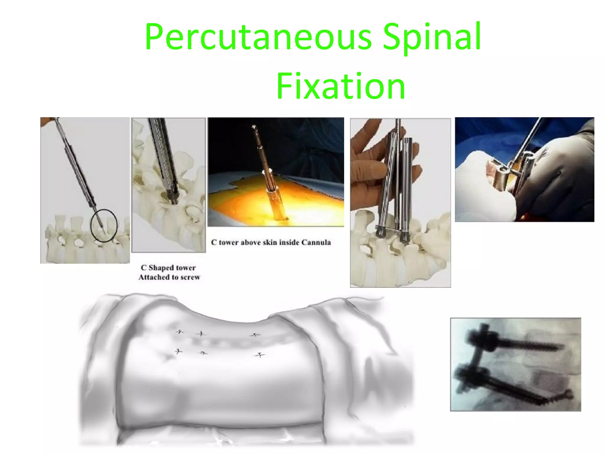 Percutaneous Spinal
Fixation
 